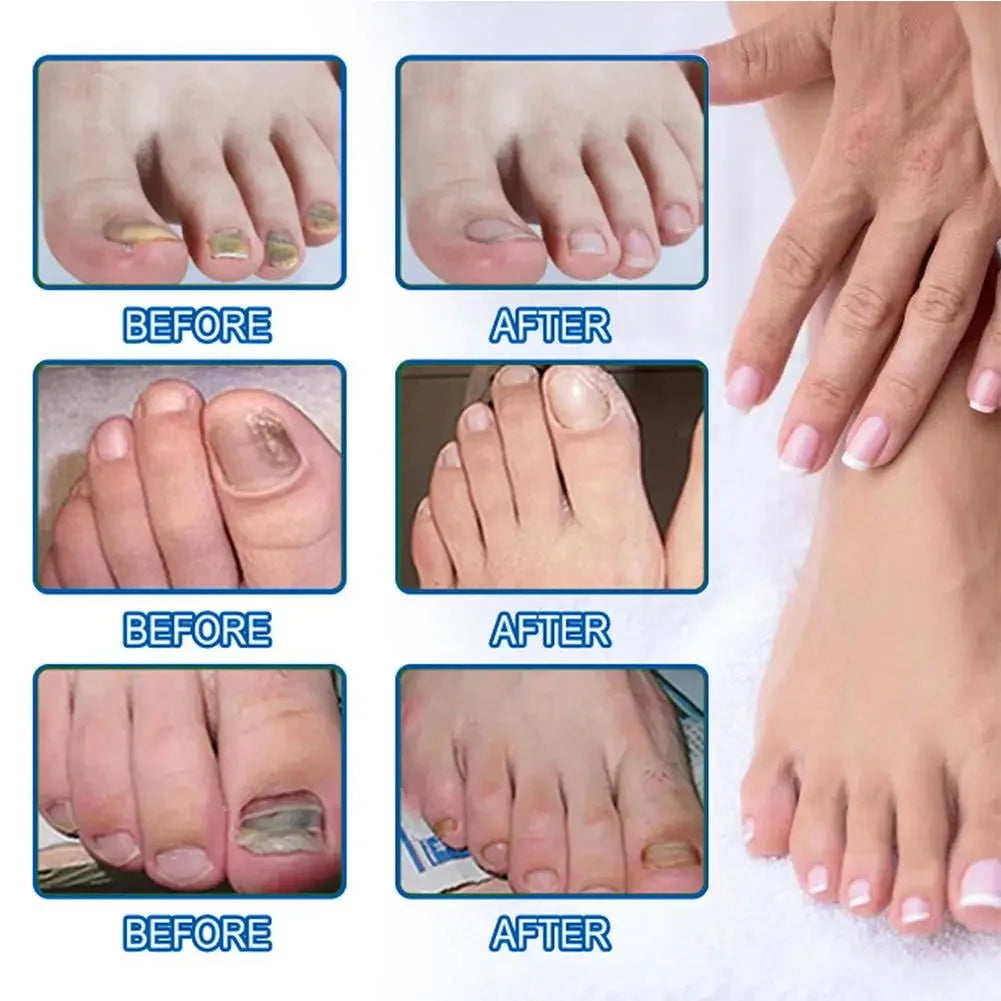 Parches Reparadores Discretos para Uñas con Hongos — foto 5